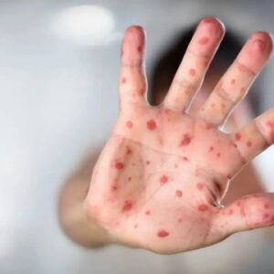 Casos de sarampión superan los 15 mil